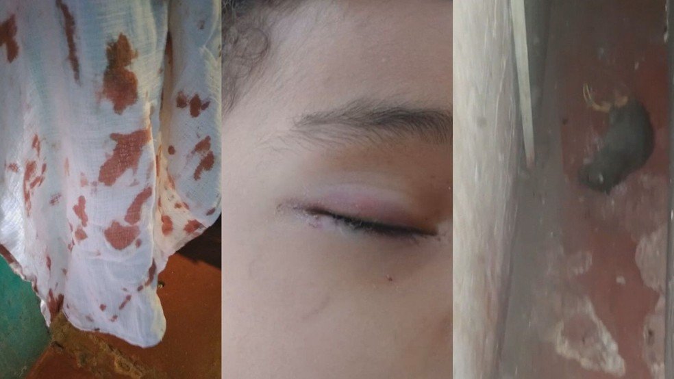 Criança fica ferida no rosto após ser atacada por rato enquanto dormia no DF