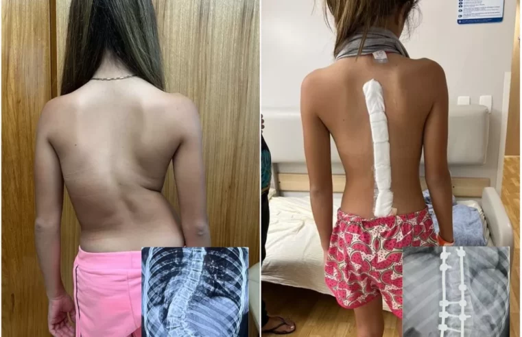 Menina com ‘coluna em S’ dá primeiros passos após cirurgia de correção da curvatura: ‘Momento maravilhoso’, diz mãe
