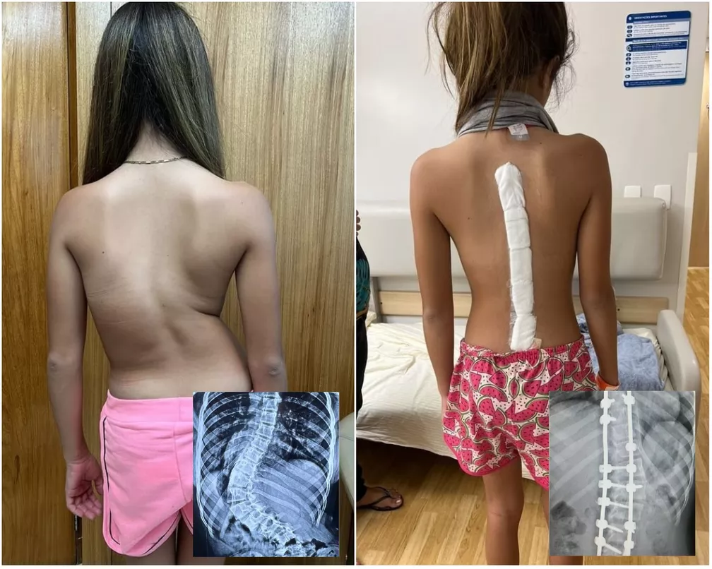 Menina com ‘coluna em S’ dá primeiros passos após cirurgia de correção da curvatura: ‘Momento maravilhoso’, diz mãe