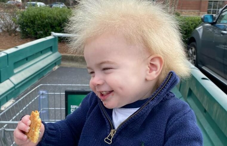 Saiba o que é a “síndrome do cabelo impenetrável”, diagnosticada em bebê nos EUA