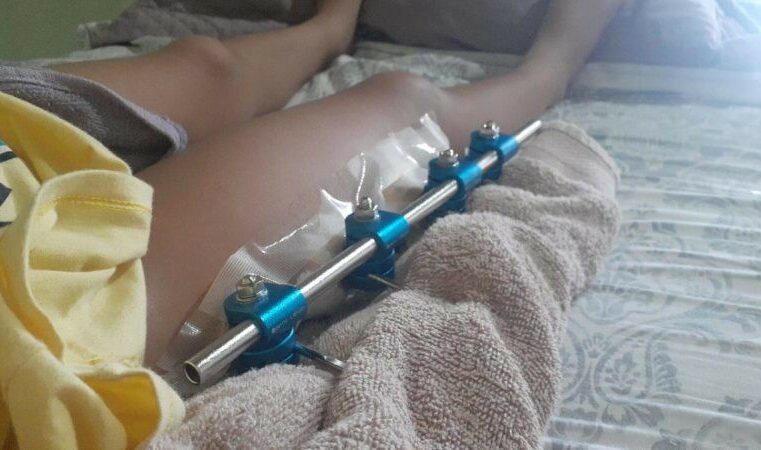 Menina de 4 anos tem perna quebrada após banco de praça desabar em Várzea Grande