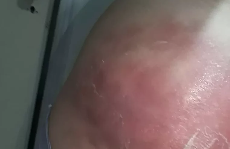 Mulher fica com bumbum deformado após injeção em SP e perde até o emprego: ‘parece amassado’