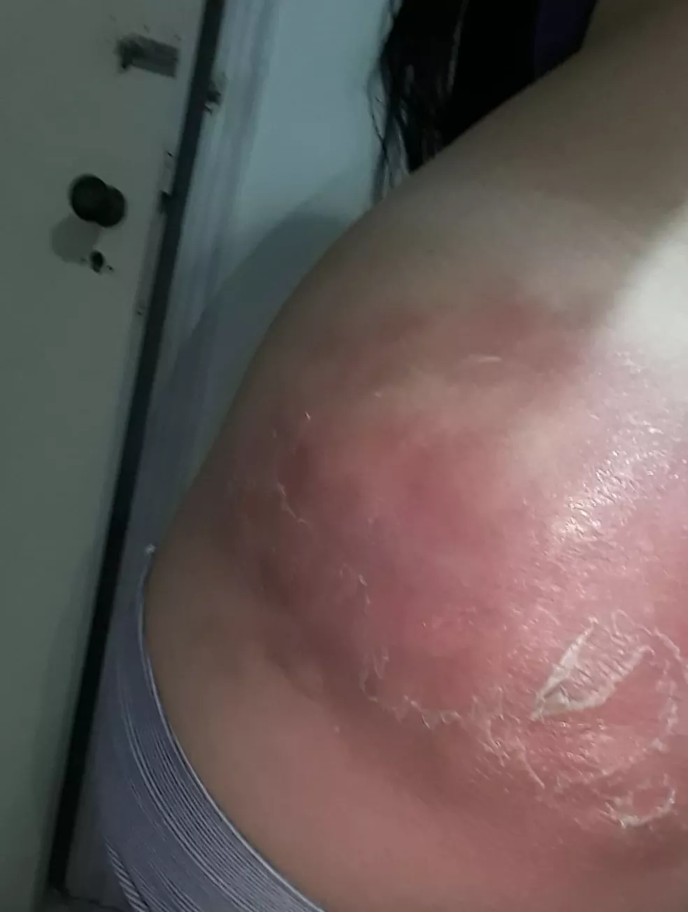 Mulher fica com bumbum deformado após injeção em SP e perde até o emprego: ‘parece amassado’