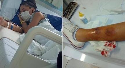 Menina de 14 anos é picada em atividade escolar e pode perder a perna