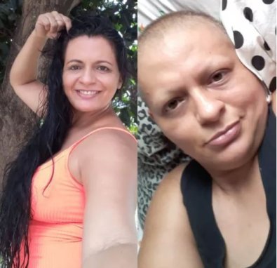 Mulher descobre câncer avançado após médico dizer que era gordura em Cuiabá