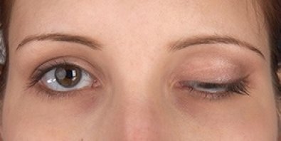 “Cobaia” aciona dentista após botox deixar rosto necrosado em Cuiabá