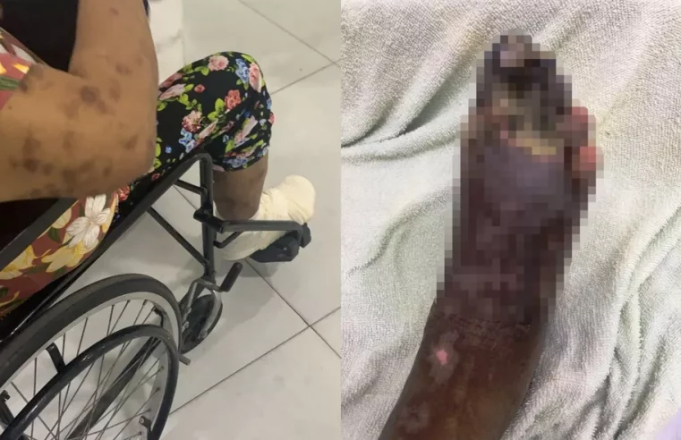 Mulher vê perna necrosar após ferir o pé e lutar nove dias por atendimento em SP: ‘verdadeiro descaso’