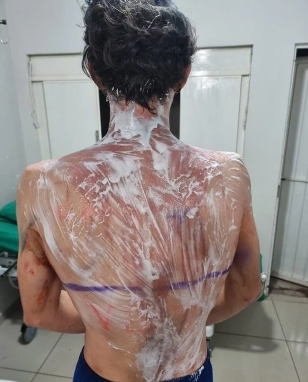 Estudantes de medicina veterinária sofrem queimaduras em trote da UFPR