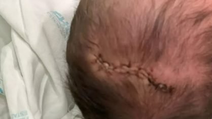 Bebê cai de cabeça depois do parto e leva 11 pontos em MG