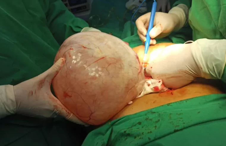 Médicos retiram cisto de 5 kg do ovário de idosa durante cirurgia de emergência no Sul do Piauí
