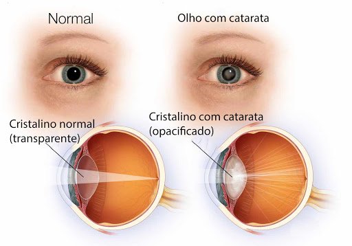 Estudo associa cirurgia de catarata à redução no risco de demência