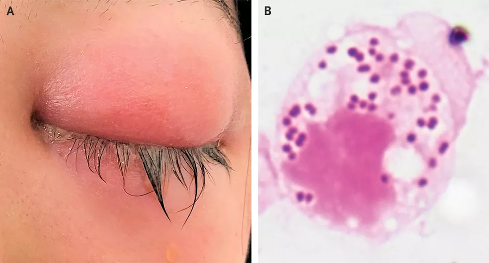 Infecção sexualmente transmissível pode afetar os olhos; entenda o que é a conjuntivite gonocócica e como se proteger