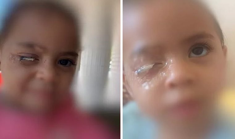 DF: Menina de 2 anos vai parar no hospital após grudar olho com cola