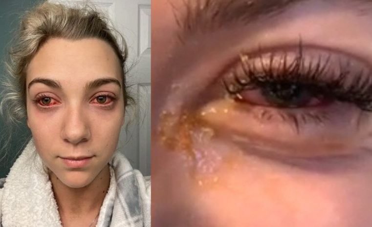 Jovem quase fica cega após fazer extensão de cílios: “Olhos de zumbi”