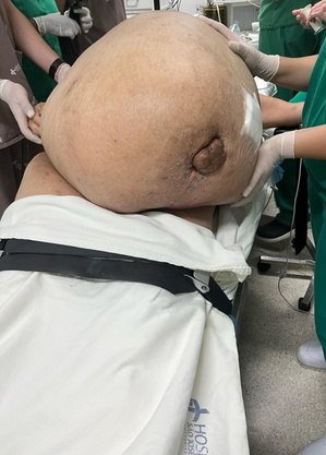 Mulher pensou que estava engordando, mas tinha um tumor de 46 kg; entenda o caso