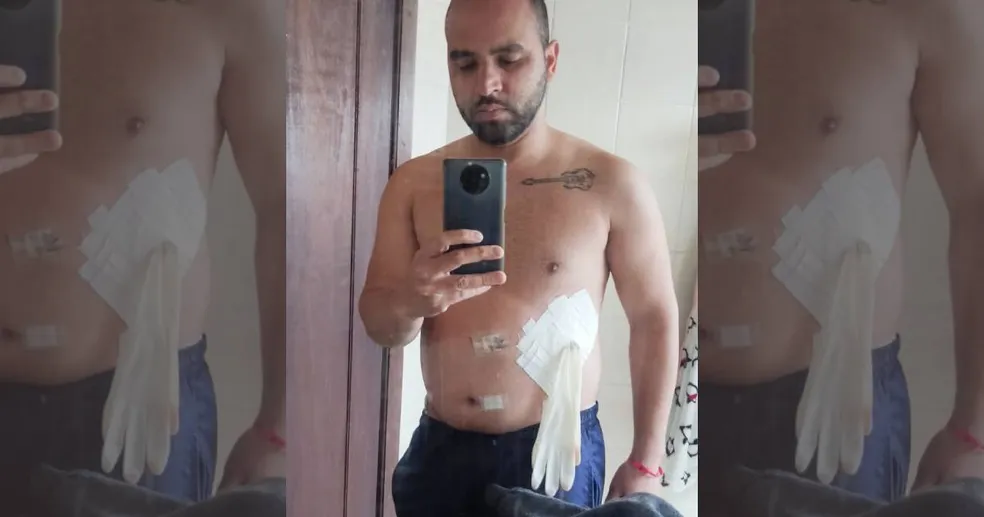 Médico coloca luva cirúrgica no lugar de bolsa de colostomia em paciente: ‘Falou que era medicina de guerra’