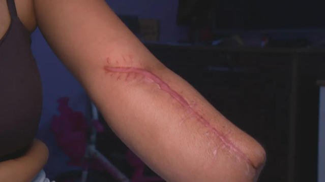 Rio: mulher vai a hospital para dar à luz e volta com mão amputada