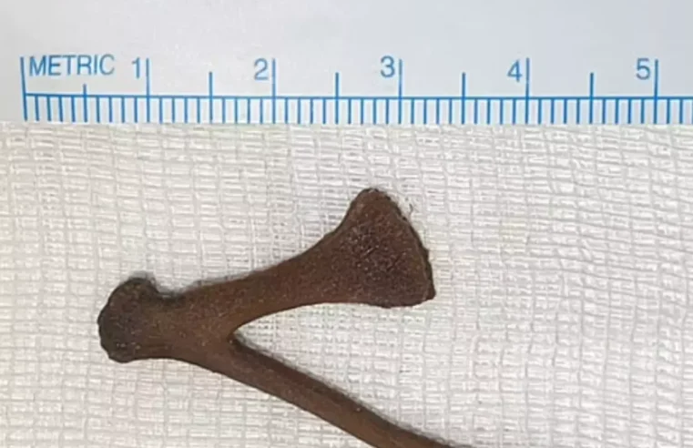 Mulher é socorrida com osso de galinha de 5 cm preso ao ânus no Kuwait